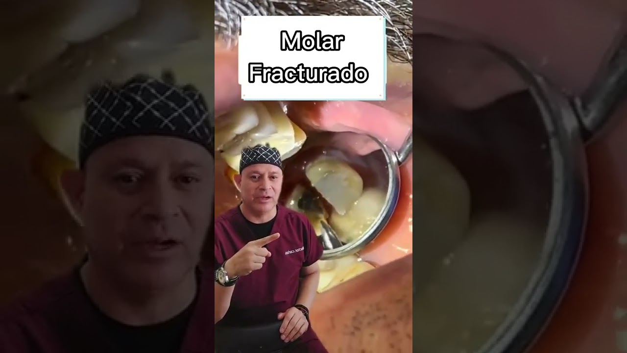 MUELA FRACTURADA
