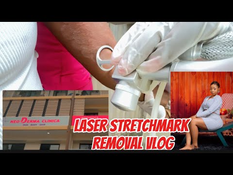 Laser Stretchmark Removal Vlog in Kigali rwanda |Cost | Pain | recovery all explained |Amaribori