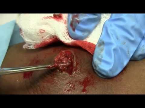 Big Abscess in the ER