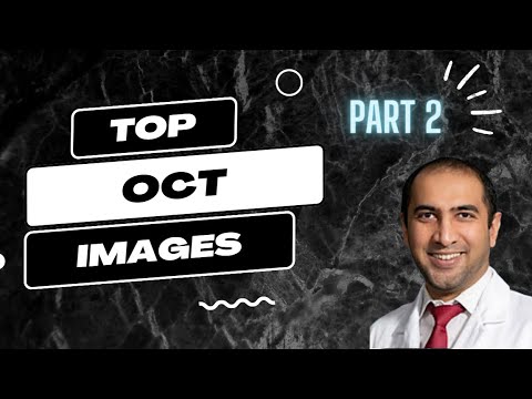 How to interpret OCT (optical tomography coherence) imaging? Part II