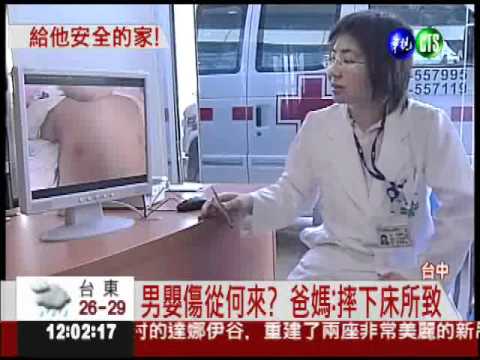 鎖骨折.咬傷.臂腫 男嬰被凌虐?