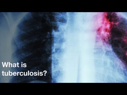 What is tuberculosis?