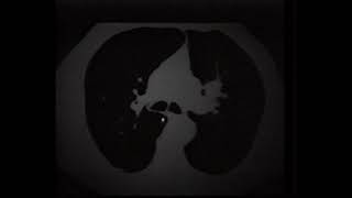 Lung  cancer