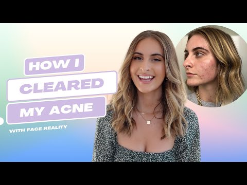 My Experience with the Face Reality Acne Program