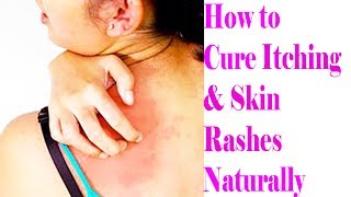 3 Most Effective And Easy Home Remedies For Itchy Skin | How to Cure Itching & Skin Rashes Naturally