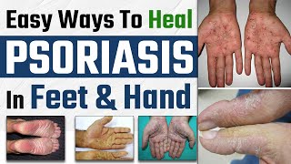 Palmoplantar Psoriasis Symptoms & Treatment | Easy Ways To Heal Psoriasis In Feet & Hand |Dr Health