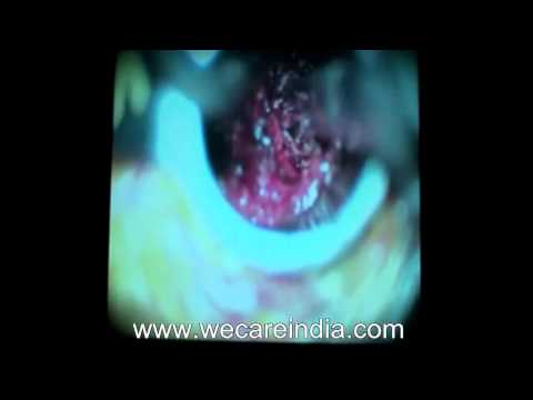 download lagu mp3 mp4 Spine Surgery Cost In Mumbai, download lagu Spine Surgery Cost In Mumbai gratis, unduh video klip Spine Surgery Cost In Mumbai