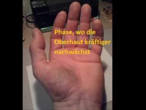 Die Erkrankung der Haut des Fotos der Schuppenflechte Die Salbe das Bienenwachs von der Schuppenflechte