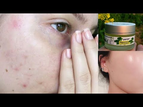 Parsh anti acne gel, pack size: 30 gms