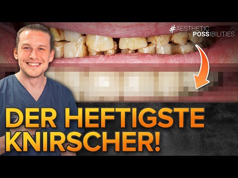 Zähneknirschen und defekte Füllungen: Oberkiefer und Unterkiefer mit Kronen und Brücken versorgt