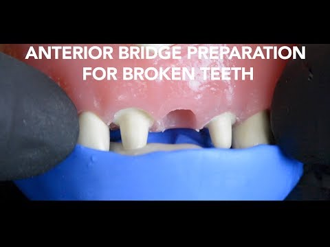 Dental Bridge Preparation after Tooth Extraction