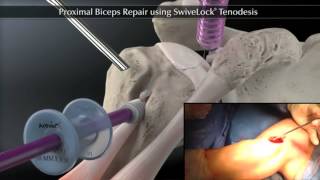 Rotura del tendón del biceps proximal de Rafael Mota