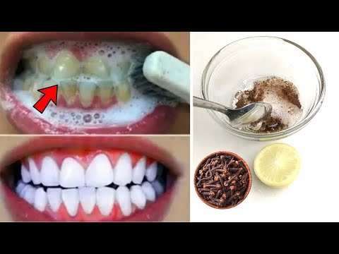 Teeth Whitening in Just a Minute - Removes Yellowing and Accumulated Tartar? 100% Effective