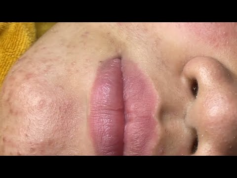 Ultimate ASMR Blackhead Removal Spa | Relaxing Skincare Session
