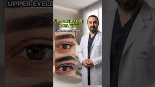 ÜST GÖZ KAPAĞI AMELİYATI, UPPER EYELID SURGERY