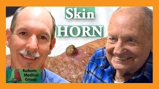 Skin HORN removal | Auburn Medical Group