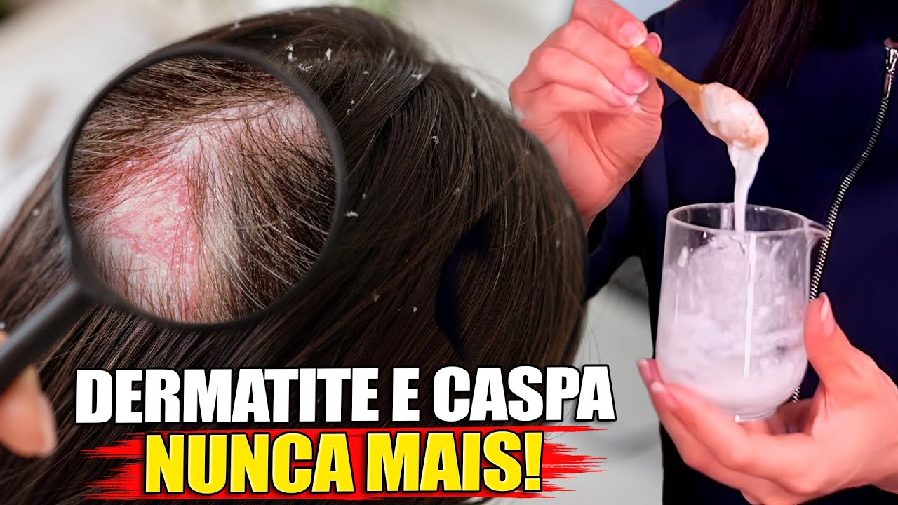 Acabe com a DERMATITE, CASPA e SEBORREIA! Receita Rápida e Caseira!