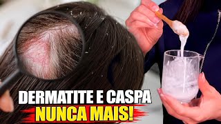 Acabe com a DERMATITE, CASPA e SEBORREIA! Receita Rápida e Caseira!