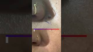 Best Mole Removal Treatment | Viral #shorts