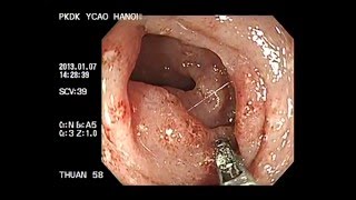 preview picture of video 'Viêm loét đại tràng - hồi tràng - crohn - ulcerative colitis'