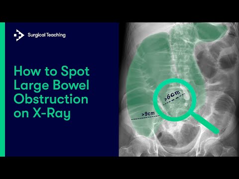 Large Bowel Obstruction | How do we  Diagnose it on Abdominal X-Ray?