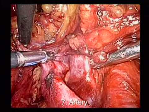 Prostate Cancer -Laparoscopic Extended Pelvic Nodes Excision