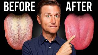 How to Get Rid of Candida in 24 Hours (And Keep It Gone)