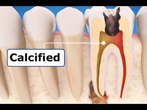 1 Secret to Finding Calcified Canals - The Calcified Canals Series Continued Part 4
