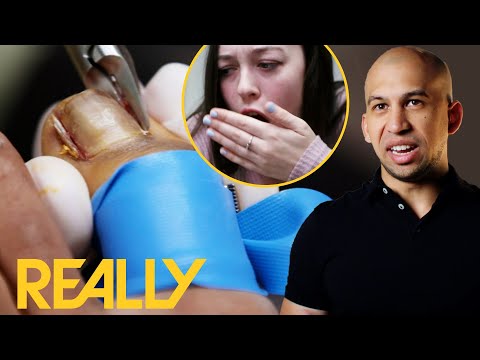 Massive Ingrown Nails Are Keeping This Dancer Away From Her Passion | The Toe Bro