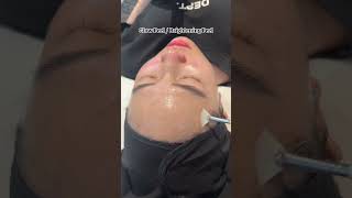 Glow Peel Treatment