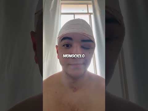 Sofri um grave acidente de monociclo 😔