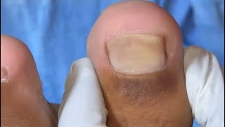 Ep_8746 Foot nails skin removal 👣 ดูสิ..ไม่ชาได้อย่างไร 😅 (clip from Thailand)
