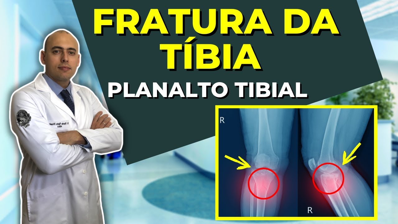 FRATURA DO TÍBIA | PLANALTO ou PLATÔ TIBIAL | JOELHO | SAIBA OS TIPOS DE FRATURA!