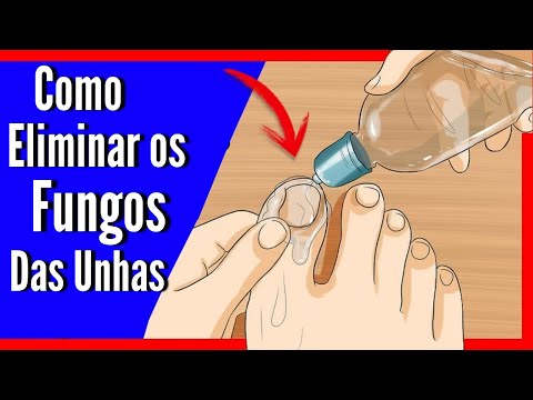 , title : 'FUNGOS Como eliminá-los com REMÉDIO CASEIRO Acabe com Fungos nas Unhas'