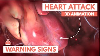 Download lagu Recognizing a heart attack | 3D Animation mp3