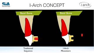 Dây Cung Siêu Đàn Hồi I ARCH