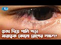 চোখ দিয়ে পানি পড়ার কারণ কি Eye Discharge Cause And T
