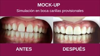Mock-up  Carillas provisionales  Clínica Dental Paseo de la Habana 77