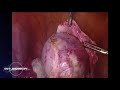 Right Dermoid Cyst Resection | Safe Laparoscopy