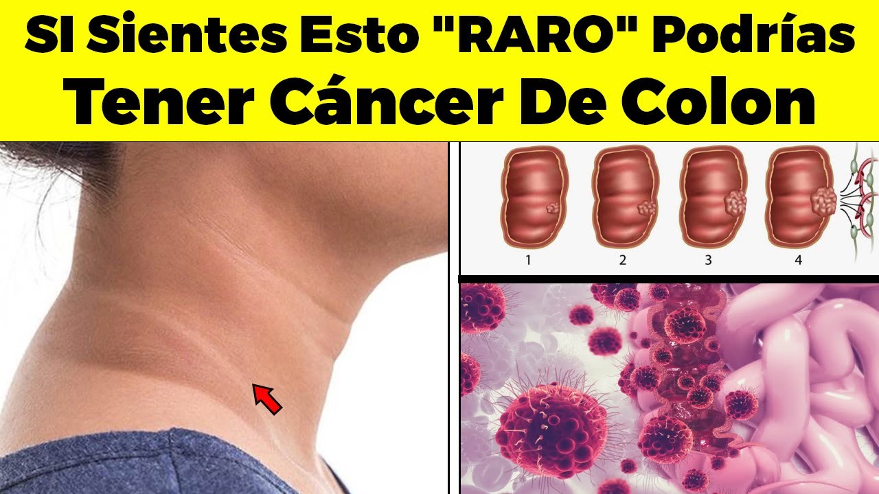 SI Sientes Esto "RARO" Podrías Tener Cáncer De Colon