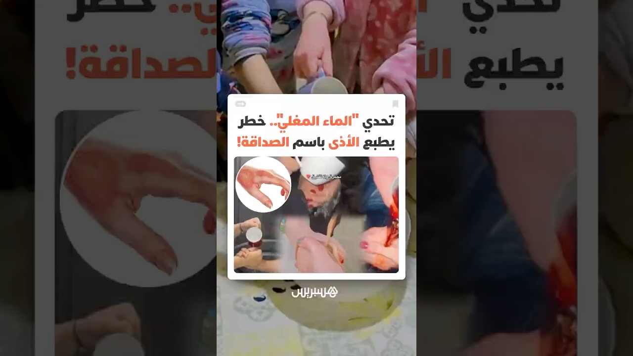 موضة خطيرة باسم الصداقة تجرّ متابعين إلى حروق وتشوهات جلدية دائمة thumbnail