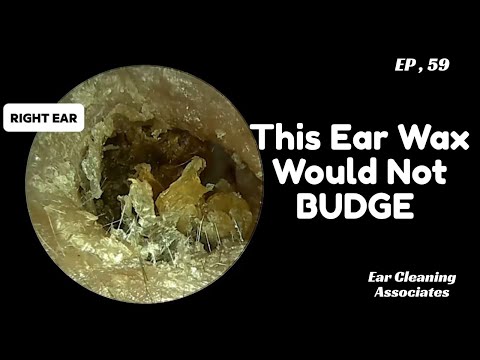 First Ear Wax Removal Experience | Large, Hardened Ear Wax Plugs Removed - EP59