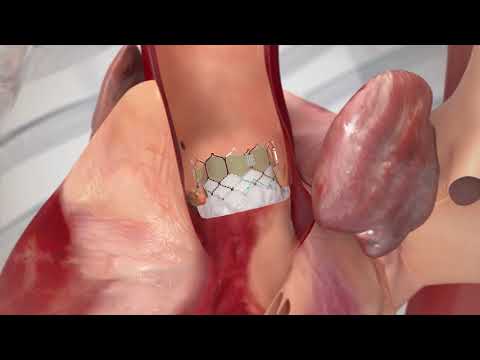 Edwards SAPIEN Transcatheter Aortic Valve Replacement (TAVR) Transfemoral Procedure Animation