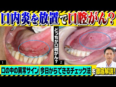 ショー優勝者、稀な腫瘍の診断を説明「口内炎だと思った」