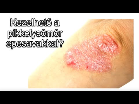 Ekcma pikkelysömör dermatitis kezelse