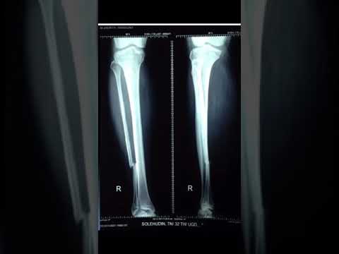 Perioada de tratament a inflamației genunchiului