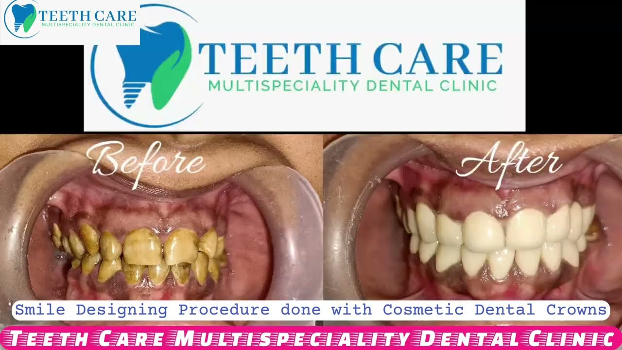 teeth whitening before after process