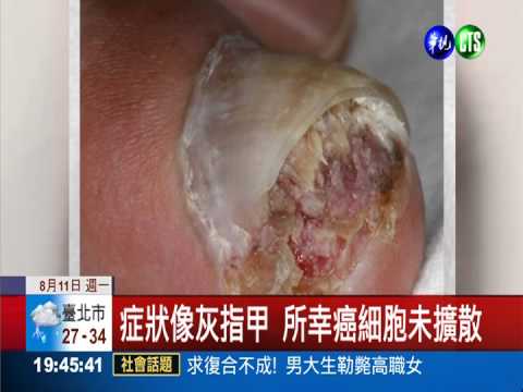 單一指甲增厚變形 男罹患皮膚癌