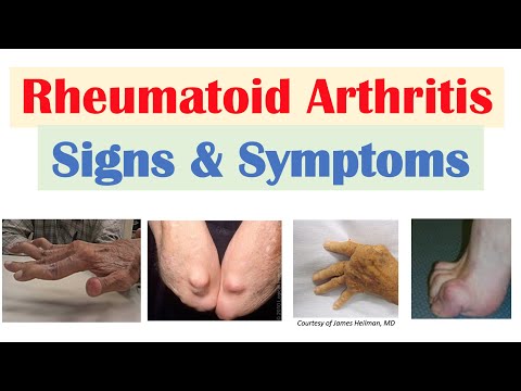 Rheumatoid Arthritis (RA) Signs & Symptoms (& Associated Complications)