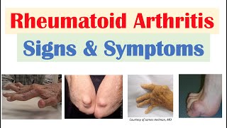 Download lagu Rheumatoid Arthritis (RA) Signs & Symptoms (& Associated Complications) mp3